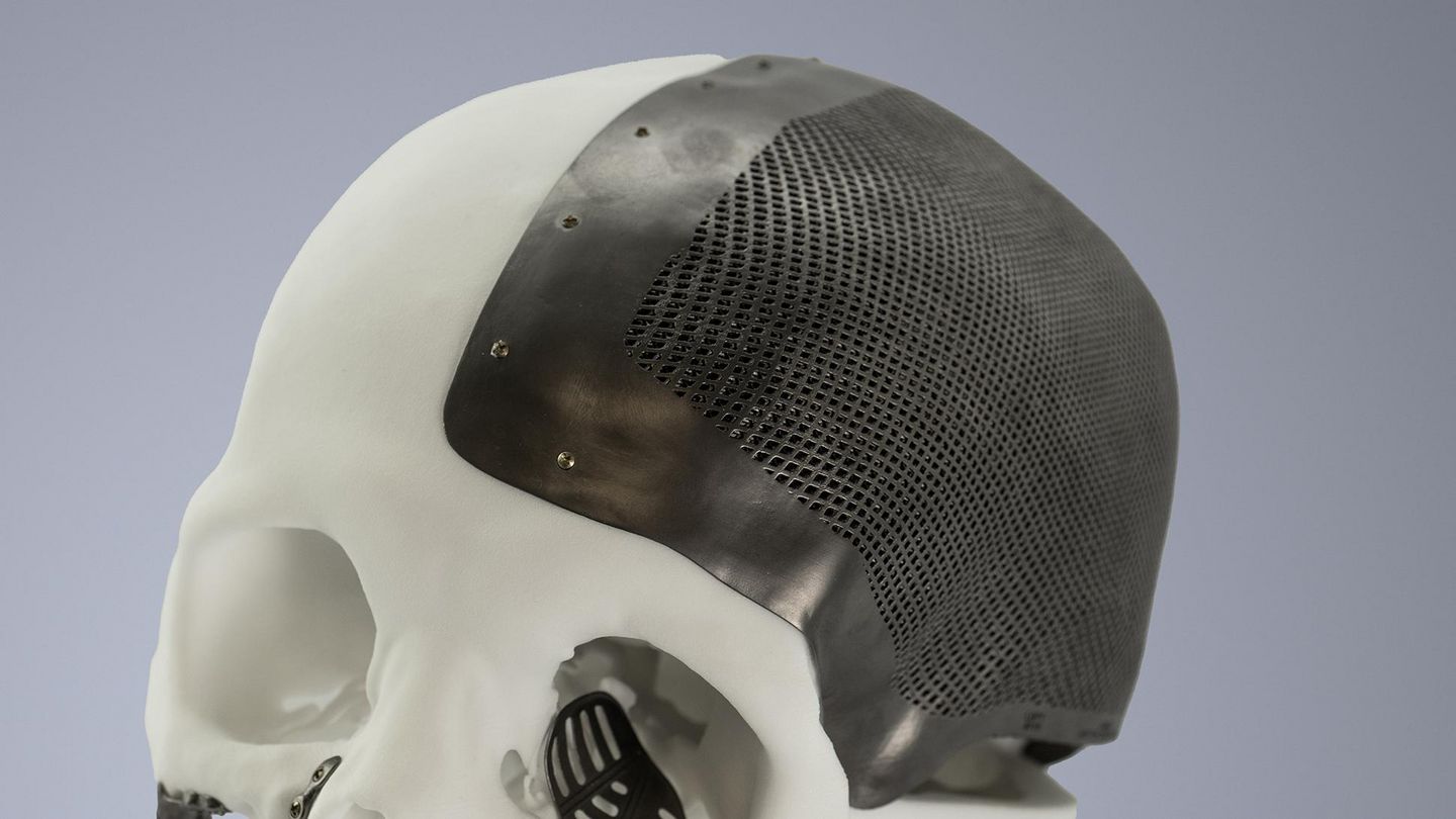 华中首例！3D打印钛合金“下颌骨”植入74岁老人面部 - 武汉大学口腔医院