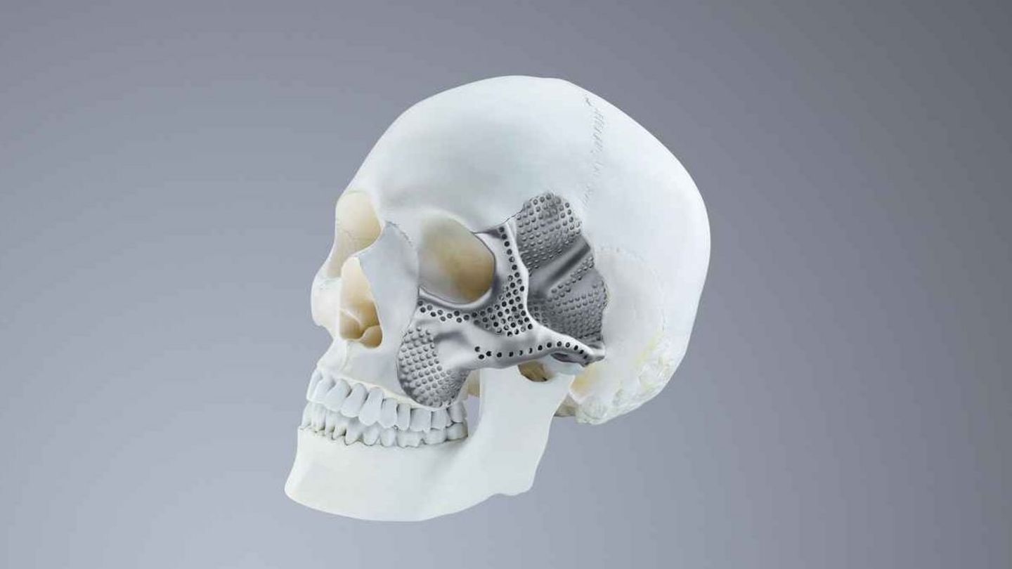 Additively manufactured, individual cranial implants made from titanium