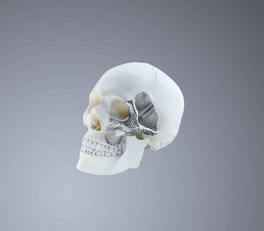 利用增材制造技术定制生产的钛金属颅内植入物